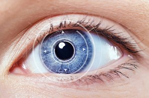 интраокулярная линза